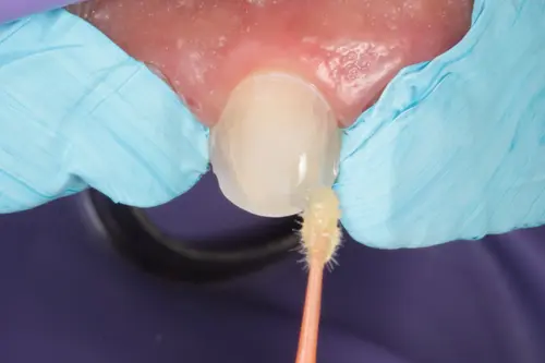 ISOTAPE - BLISTER COM 5M DE FITA DE ISOLAMENTO DEN - TDV