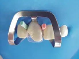 COROA DECIDUO ANTERIOR - POST C/64 REF. 4153 - TDV